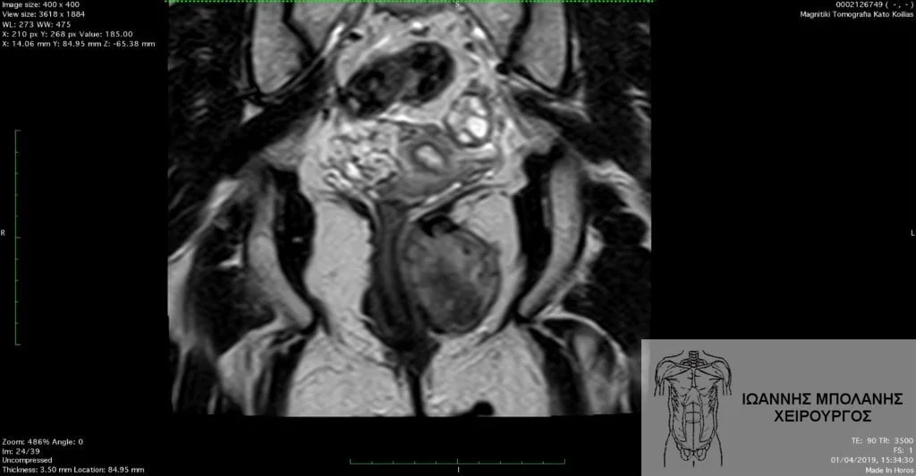 GIST pelvic tumor surgery - ogkos pyelou 2