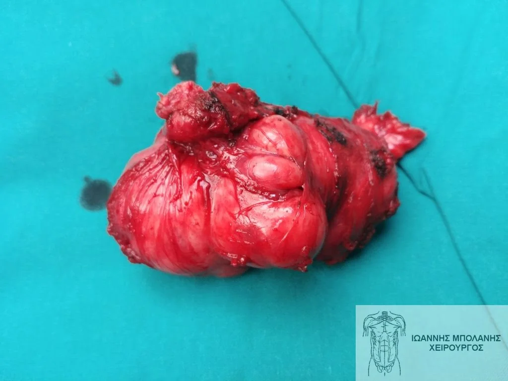 GIST pelvic tumor surgery - ogkos pyelou 3