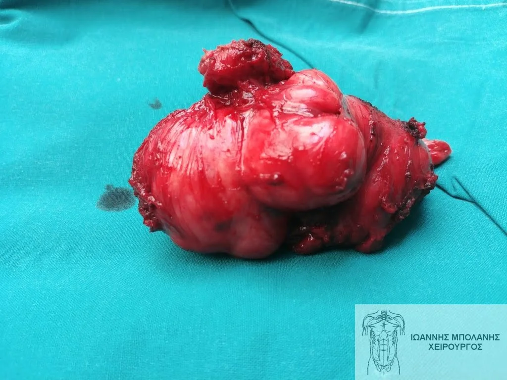 GIST pelvic tumor surgery - ogkos pyelou 4
