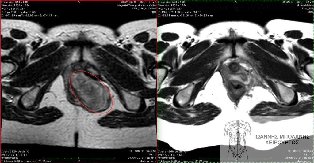 GIST pelvic tumor surgery - ogkos pyelou 5