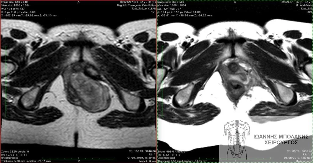 GIST pelvic tumor surgery - ogkos pyelou 6