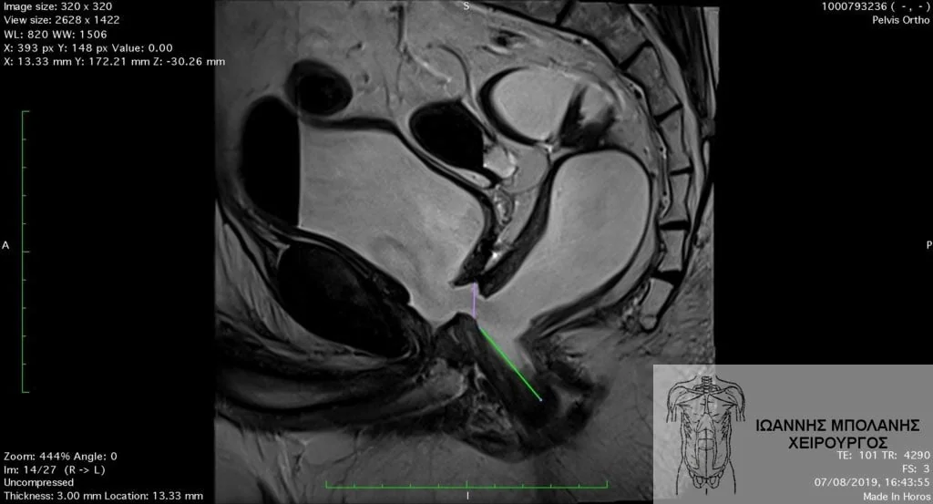 Magnetic resonance imaging fistula of the rectum with the bladder