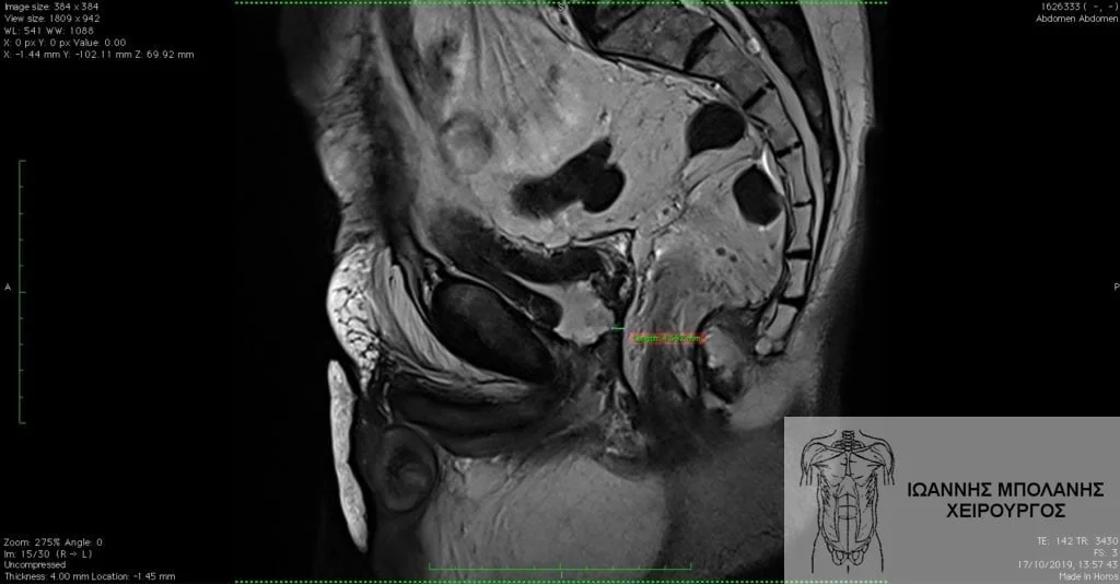  MRI where fistula correction is confirmed (green line). 