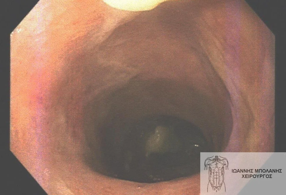 Peripheral fistula laser FiLaC® - orthokystiko sirigio 11