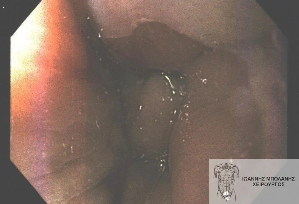 Peripheral fistula laser FiLaC® - orthokystiko sirigio 12