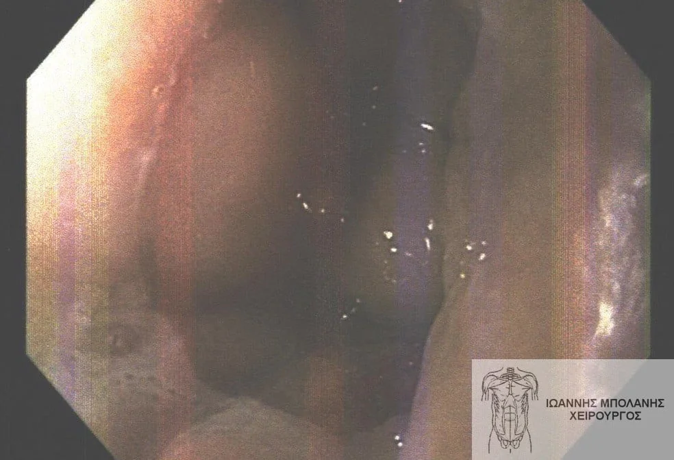 Peripheral fistula laser FiLaC® - orthokystiko sirigio 13