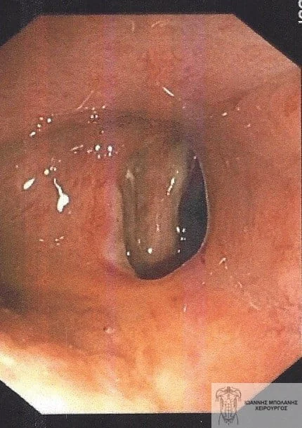 Peripheral fistula laser FiLaC® - orthokystiko sirigio 2