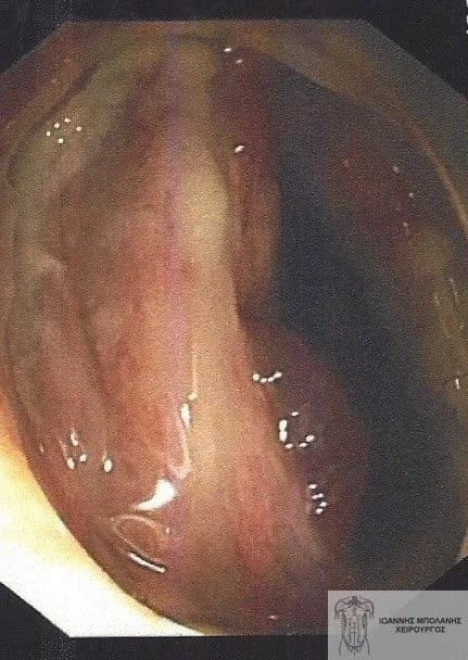 Peripheral fistula laser FiLaC® - orthokystiko sirigio 4