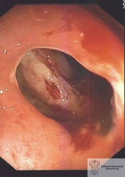 Peripheral fistula laser FiLaC® - orthokystiko sirigio 5