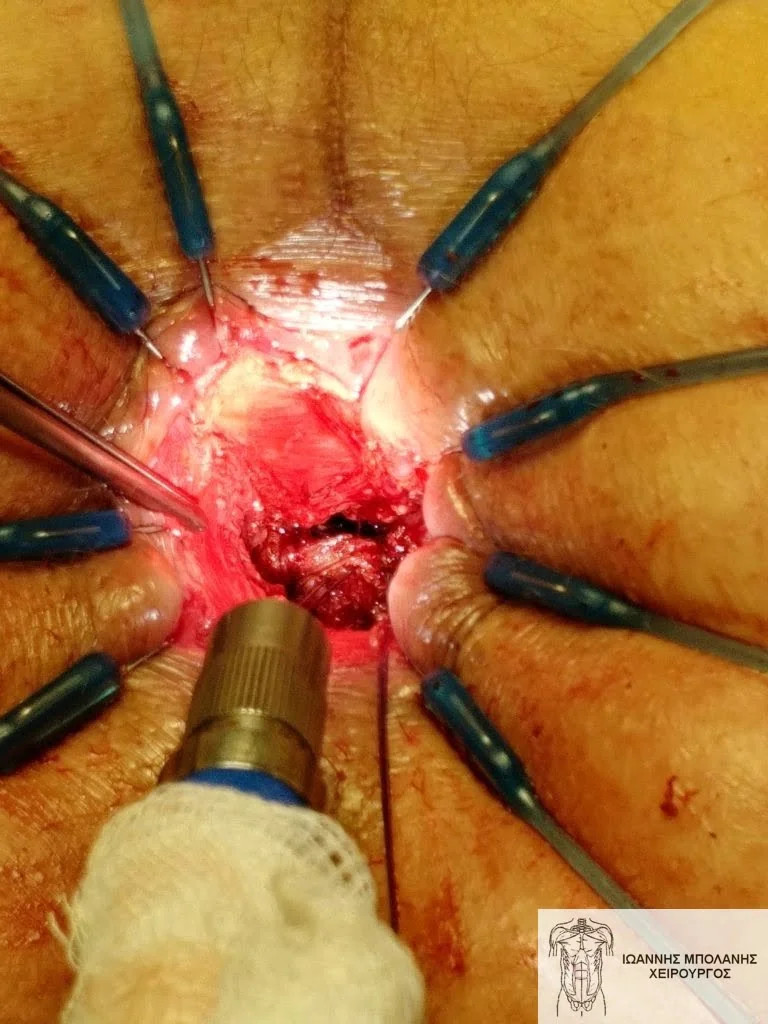 The fistula hole as seen transanally 