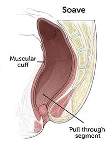Peripheral fistula laser FiLaC® - orthokystiko sirigio 7