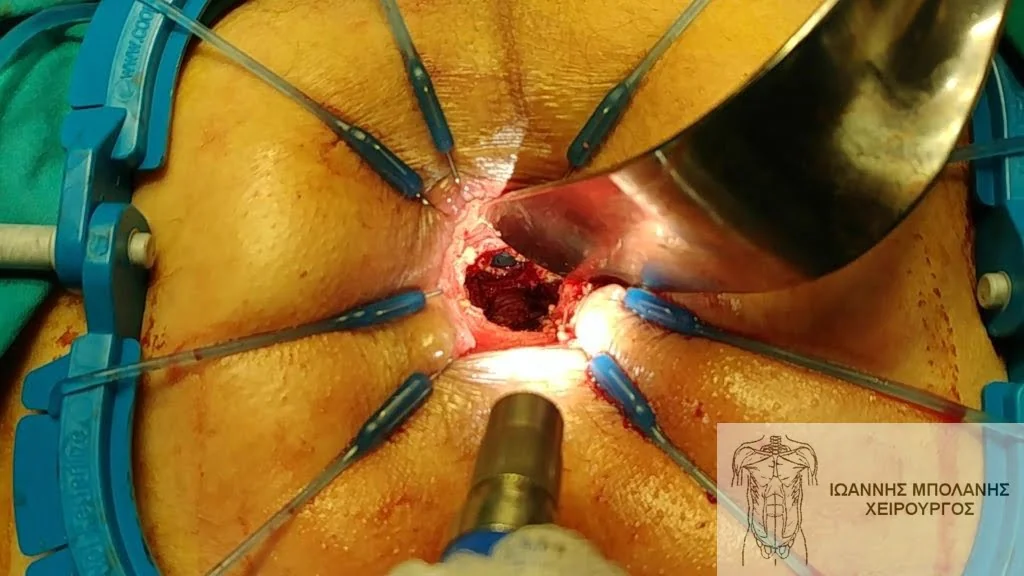  The catheter (balloon) can be seen through the fistula hole 