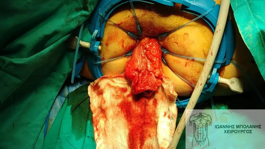  Final image of the pull-through operation 