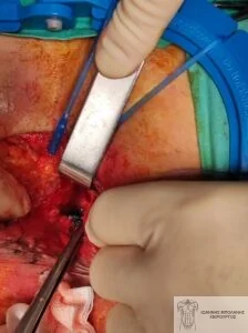 Rectal cancer without colostomy - rectocystic fistula 10