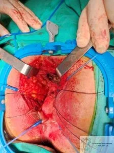 Rectal cancer without colostomy - rectocystic fistula 12