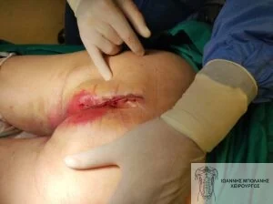 Rectal cancer without colostomy - rectocystic fistula 13