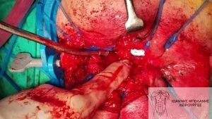 Rectal cancer without colostomy - rectocystic fistula 7