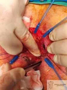 Rectal cancer without colostomy - rectocystic fistula 9