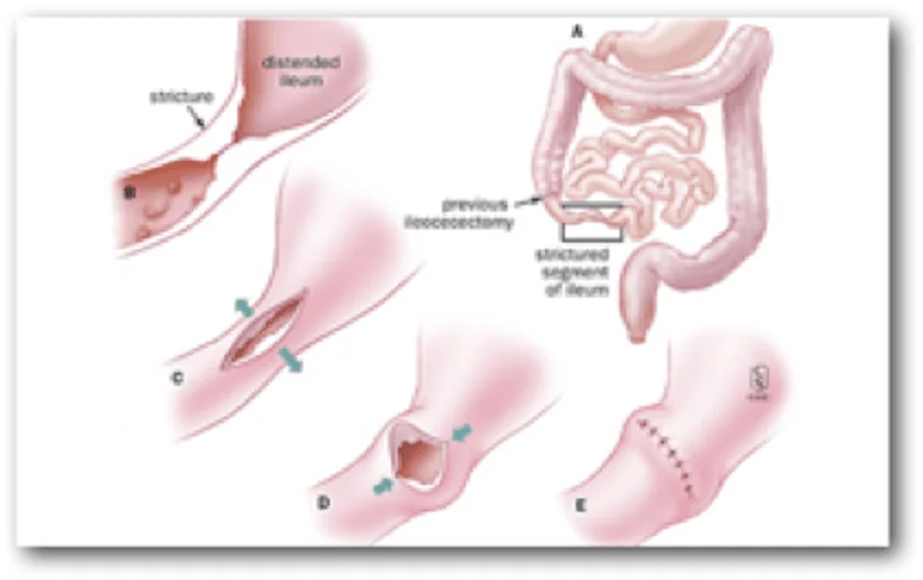 CROHN Photo 2: Stenoplasty