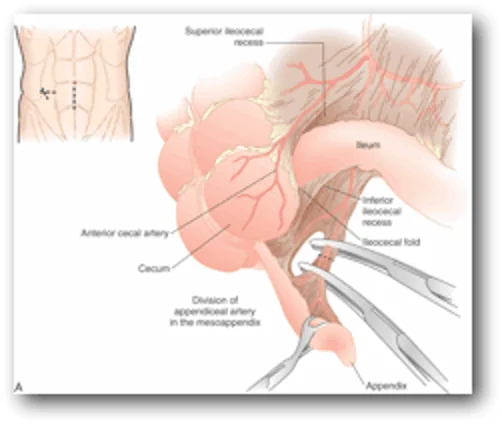 Appendicitis