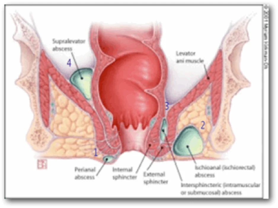 classification periodontal abscess