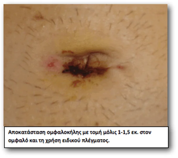 hernia umbilical hernia