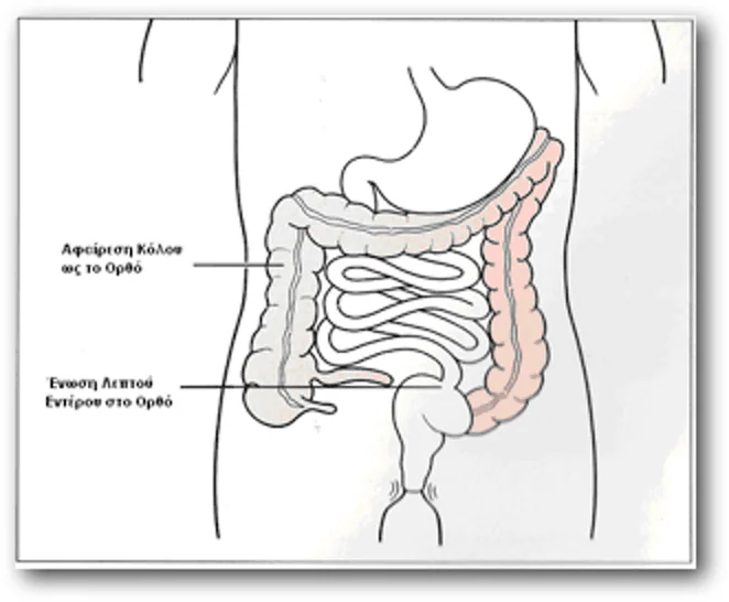 Ulcerative colitis: Colectomy and ileorectal anastomosis