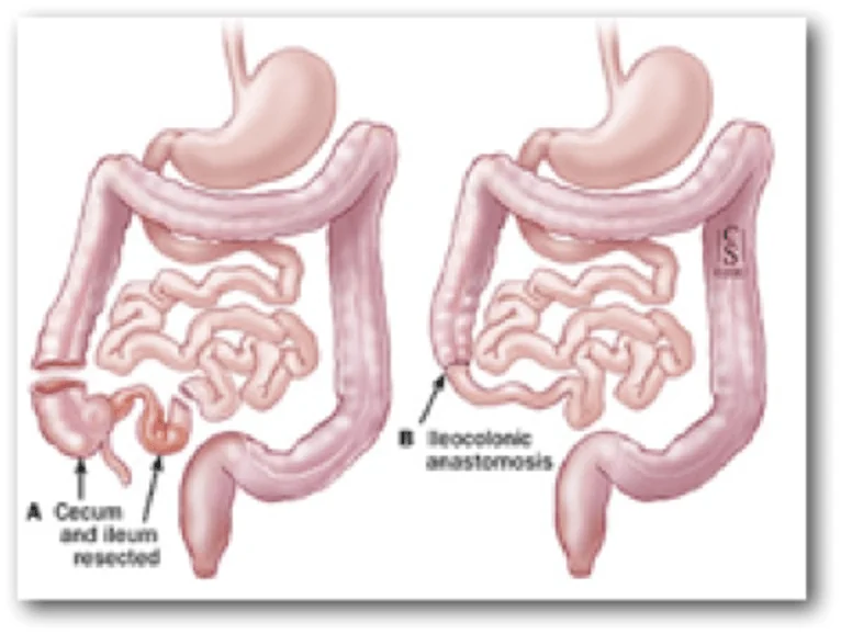 CROHN Photo 3: Resection of terminal ileum and cecum