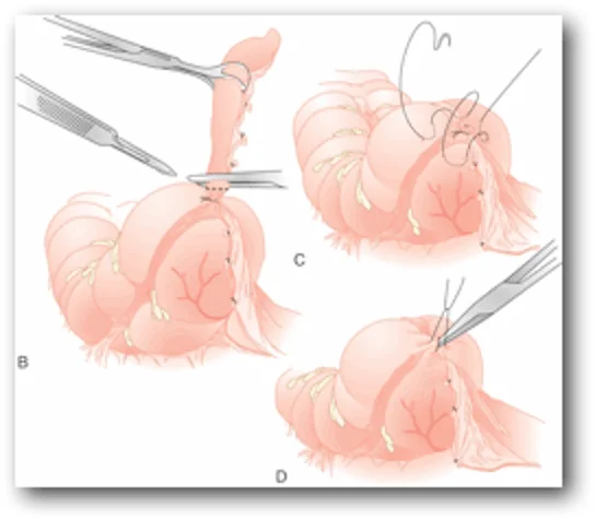 Appendicitis surgery with an open method