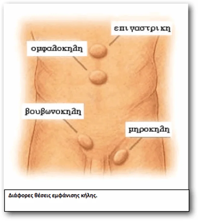  Hernia anatomy