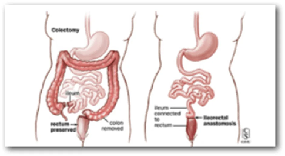 CROHN Photo 4: Ileorectal anastomosis