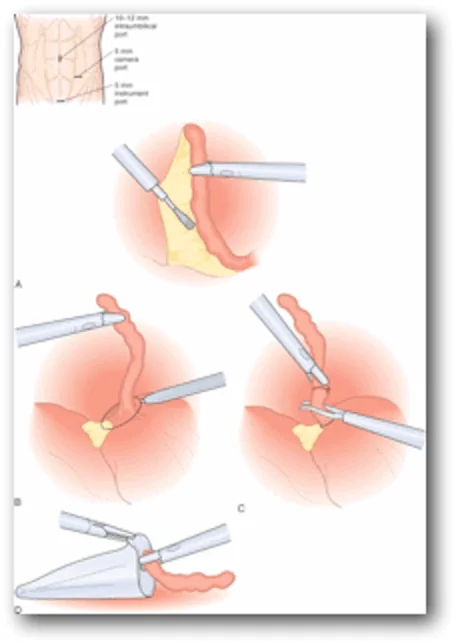 Appendicitis surgery with a laparoscopic method