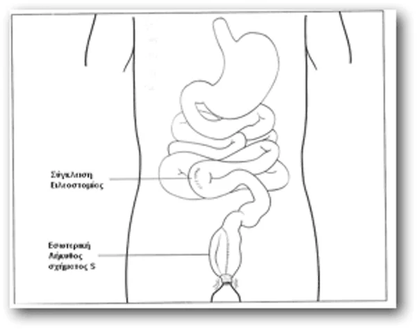 Ulcerative colitis: Ileal ulceration after temporary ileostomy closure