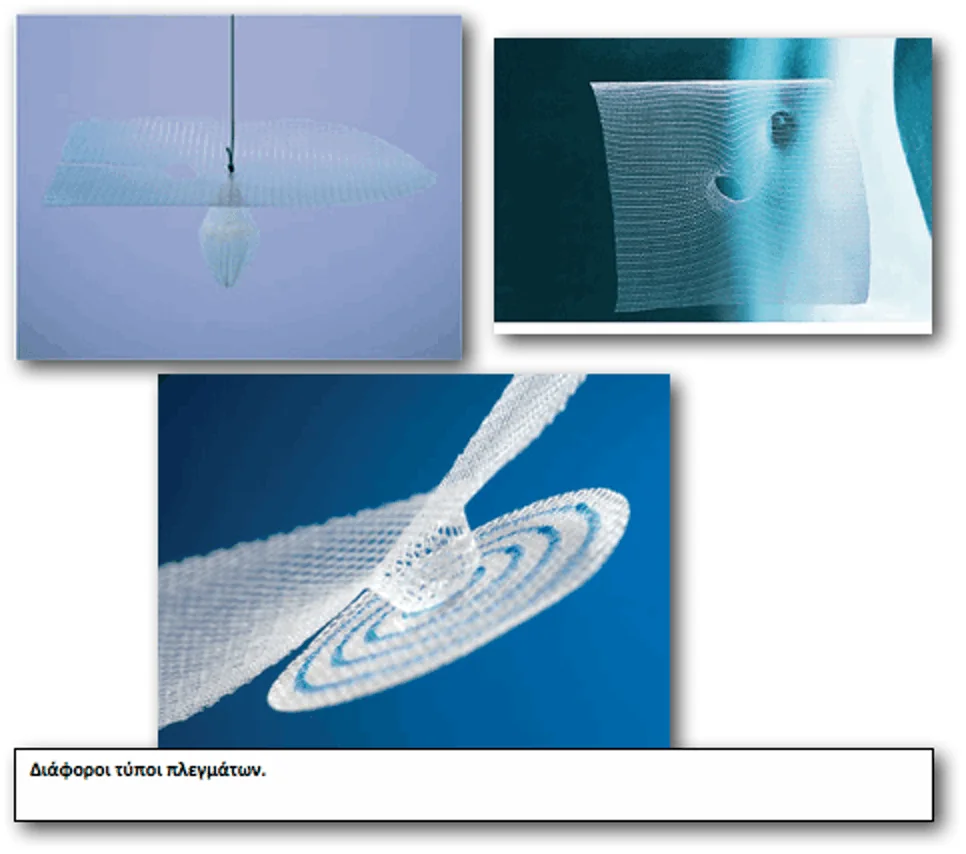 mesh hernia