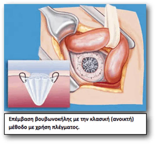 hernia inguinal hernia operation