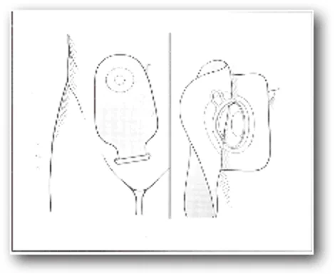 Ulcerative colitis: Permanent ileostomy