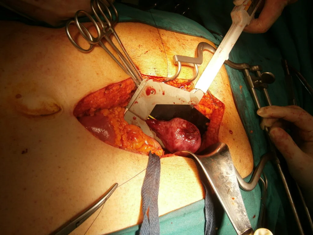 Stomach GIST stromal tumor
