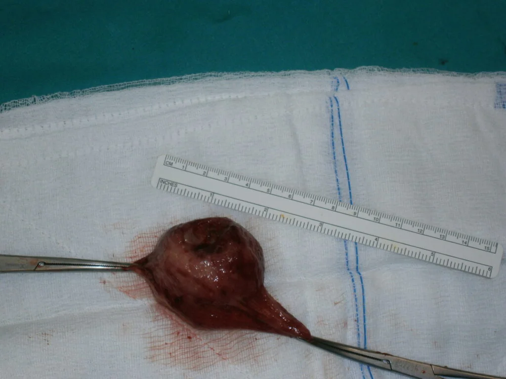 Stomach GIST stromal tumor