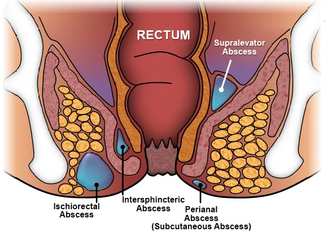 periodical abscess diagram