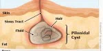 Coccyx cyst