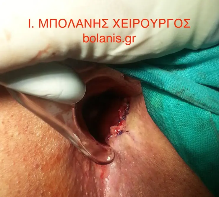 Ραγάδα πρωκτού αντιμετώπιση - ragada plastike me kremno