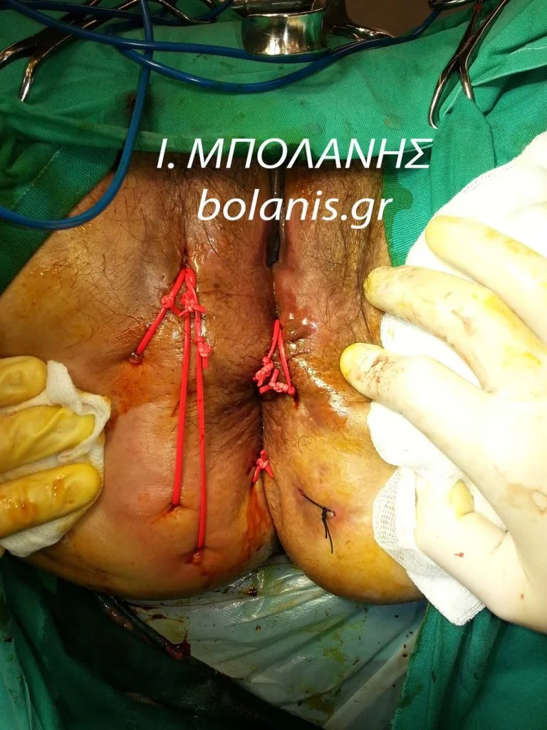 Peripheral fistula laser FiLaC® - sirigio1
