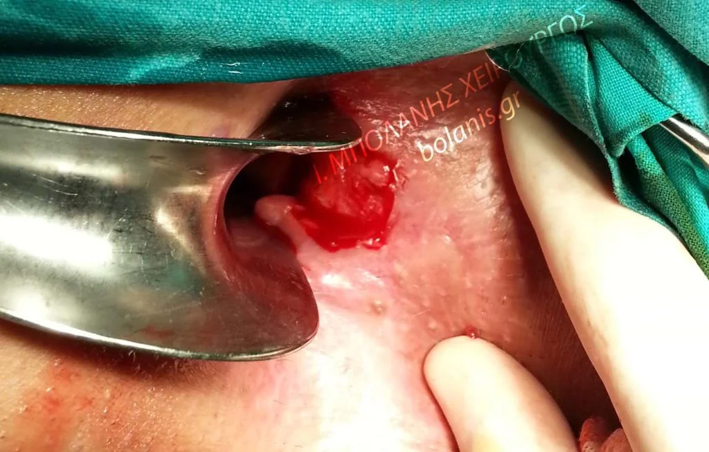 Peripheral fistula laser FiLaC® - sirigio11