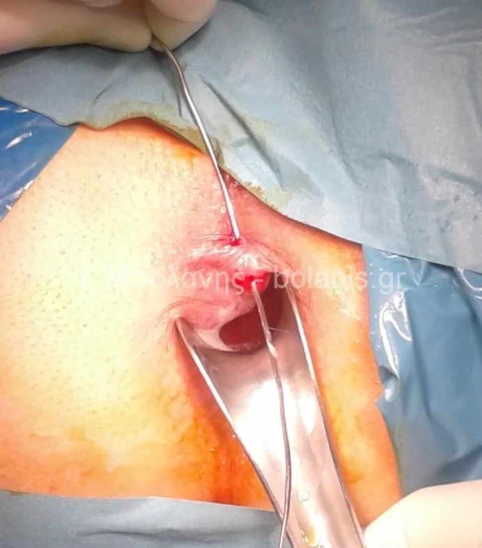 Peripheral fistula laser FiLaC® - sirigio2