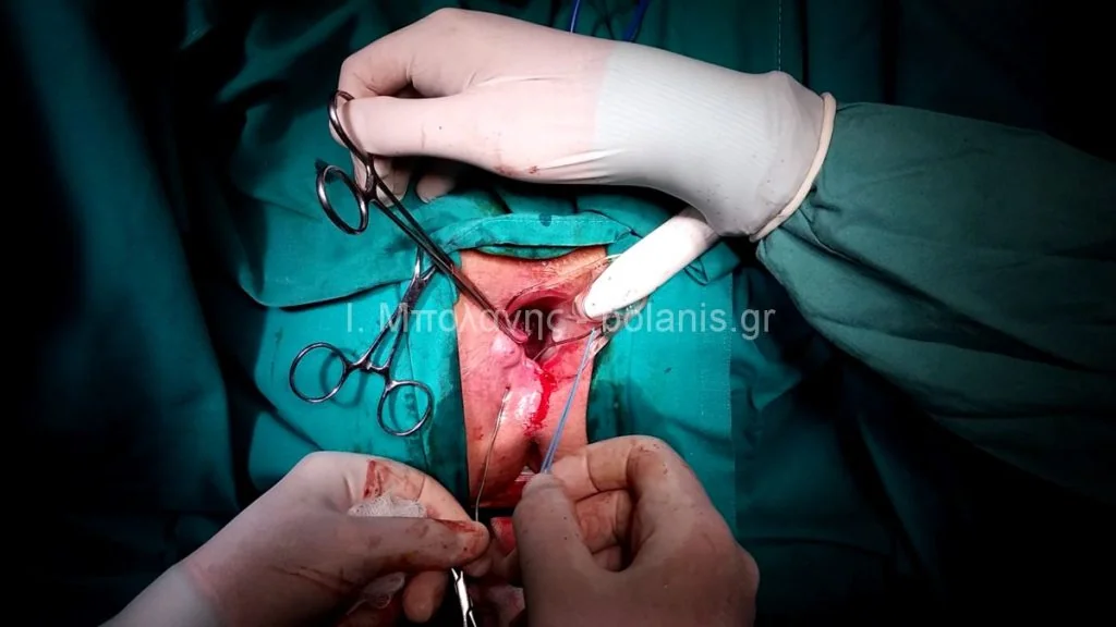 Peripheral fistula laser FiLaC® - sirigio4