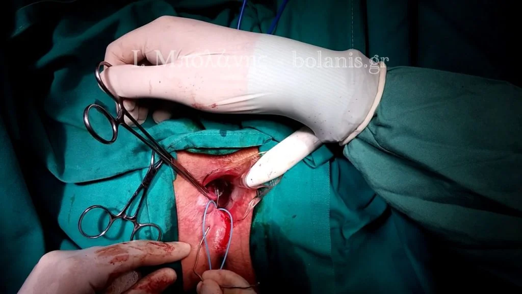 Peripheral fistula laser FiLaC® - sirigio5