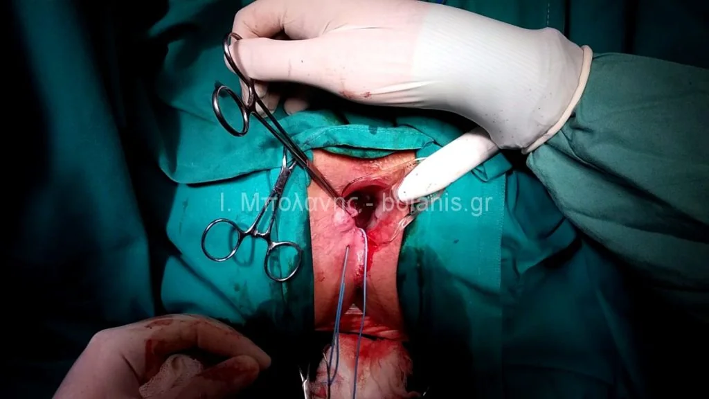 Peripheral fistula laser FiLaC® - sirigio6