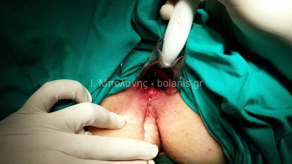 Peripheral fistula laser FiLaC® - sirigio7
