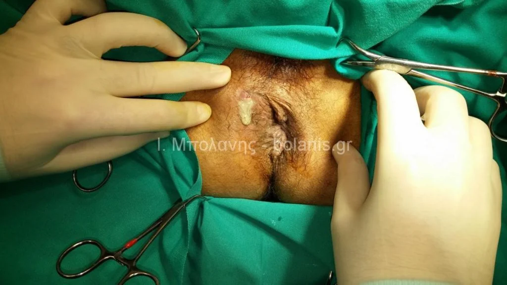 Peripheral fistula laser FiLaC® - sirigio8