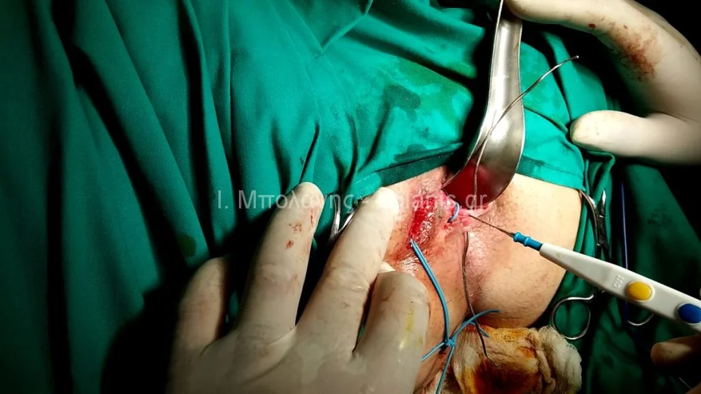 Peripheral fistula laser FiLaC® - sirigio9